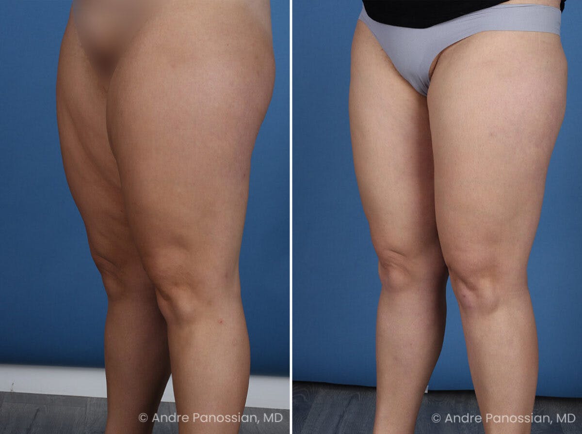 Thighplasty Before & After Gallery - Patient 277458 - Image 4