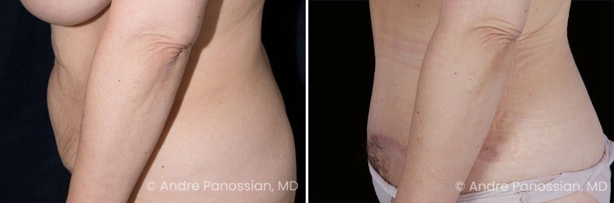Tummy Tuck Before & After Gallery - Patient 220086 - Image 4