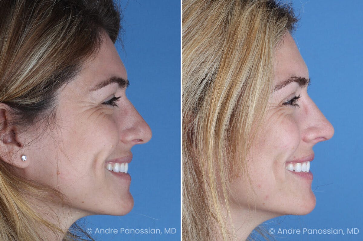 Rhinoplasty Before & After Gallery - Patient 303679 - Image 4