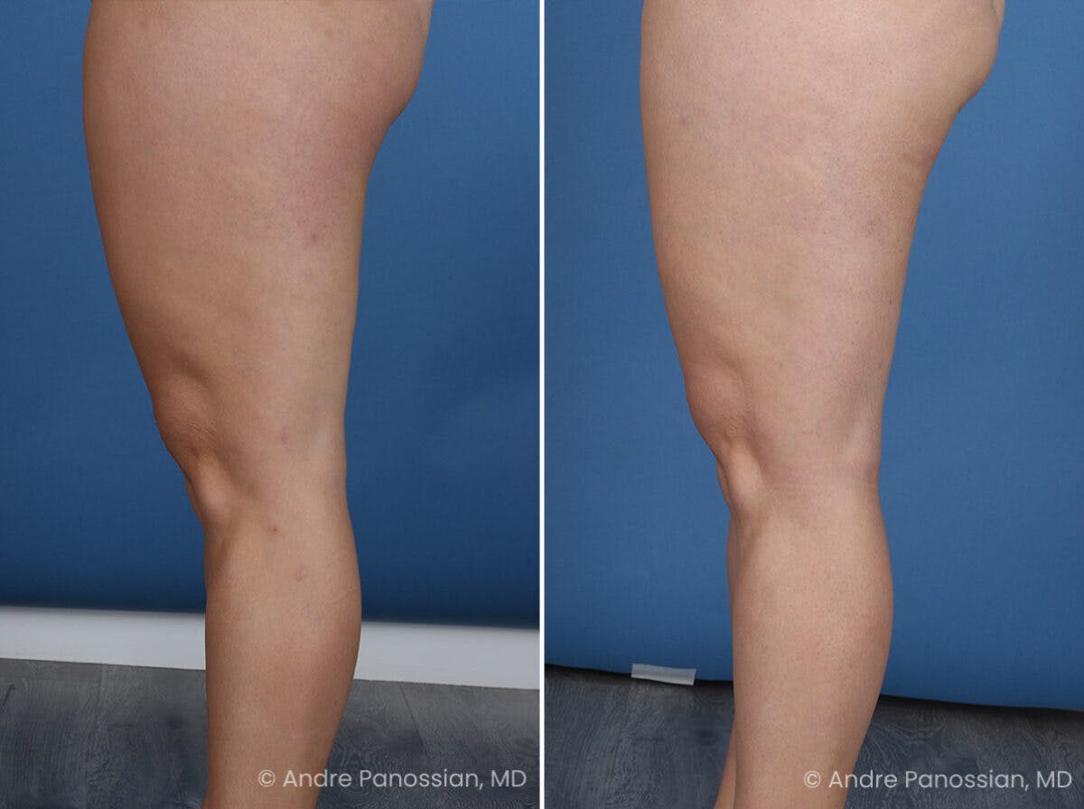 Thighplasty Before & After Gallery - Patient 277458 - Image 5