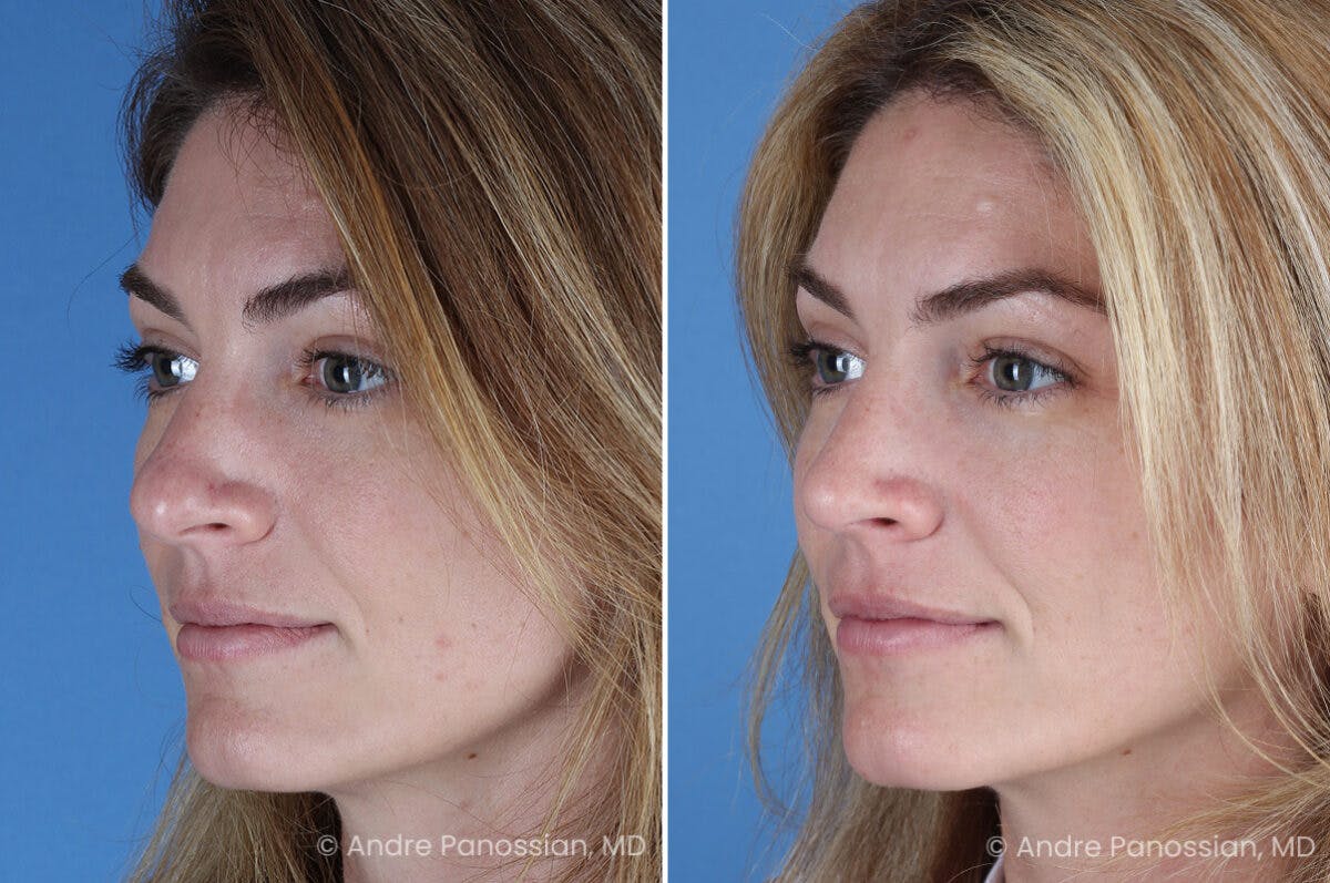 Rhinoplasty Before & After Gallery - Patient 303679 - Image 5