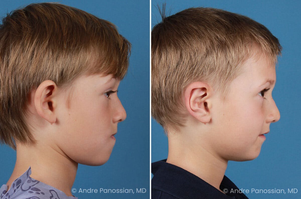 Ear Pinning (Otoplasty) Before & After Gallery - Patient 218645 - Image 3