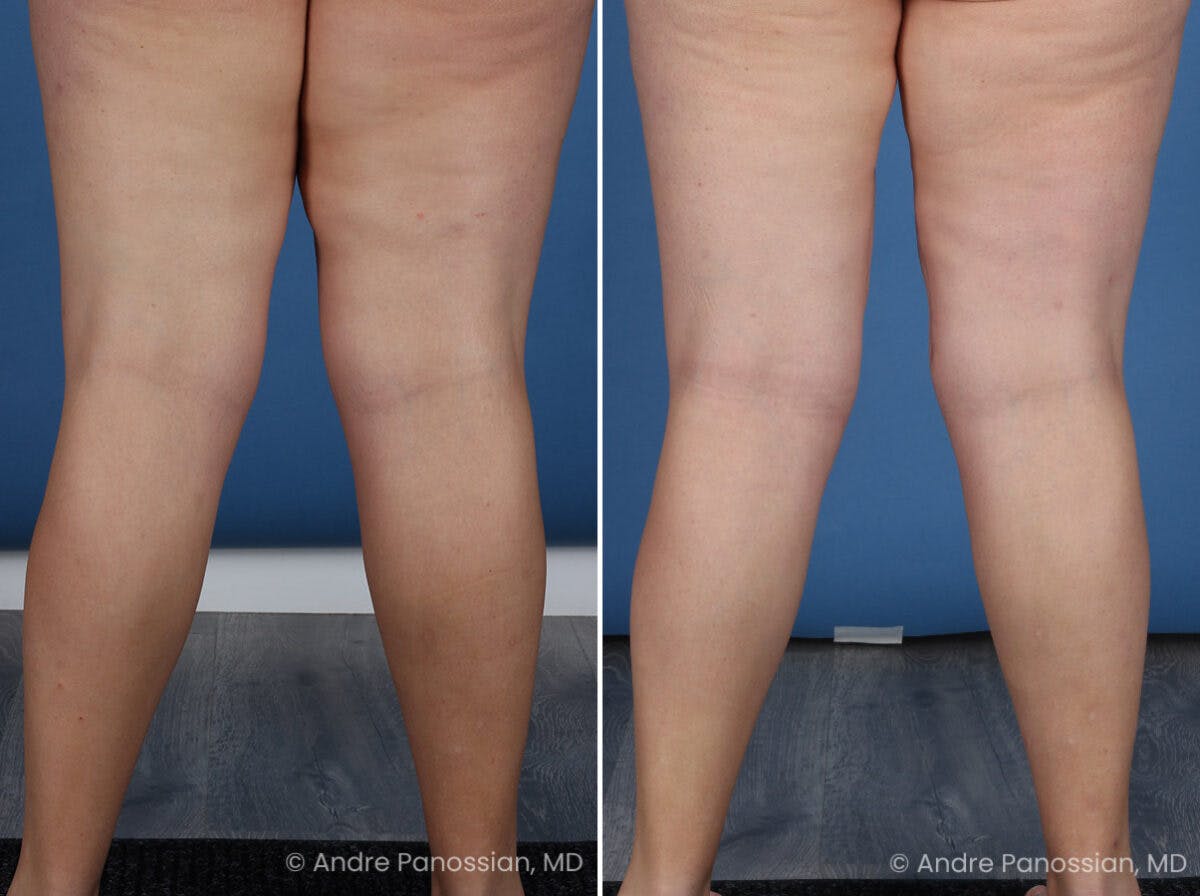 Thighplasty Before & After Gallery - Patient 277458 - Image 6