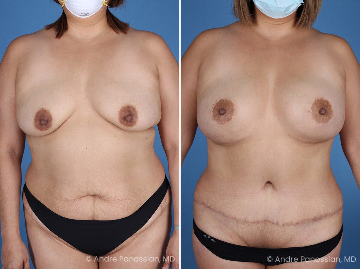 Mommy Makeover Before & After Gallery - Patient 319274 - Image 1