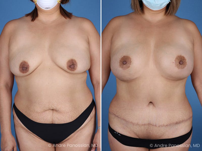 Mommy Makeover Before & After Gallery - Patient 319274 - Image 1