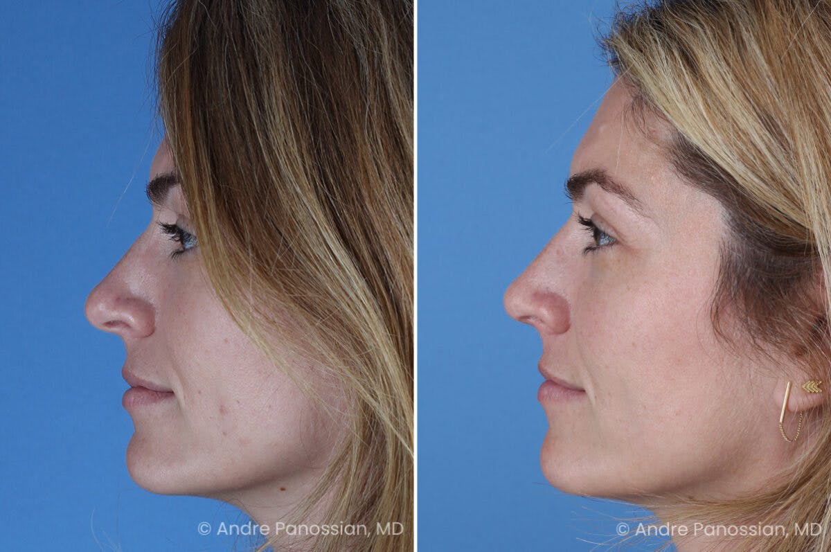 Rhinoplasty Before & After Gallery - Patient 303679 - Image 6