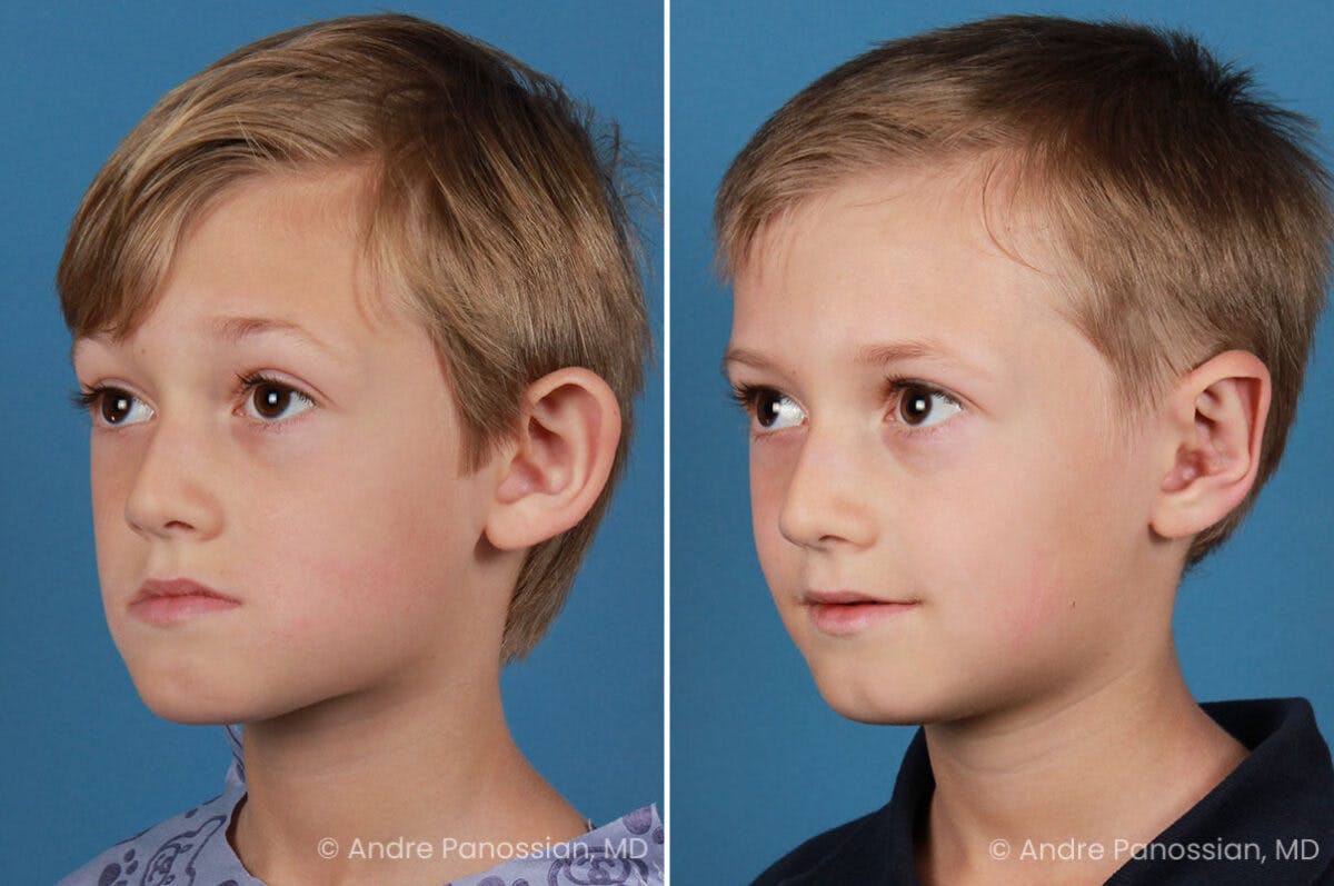Ear Pinning (Otoplasty) Before & After Gallery - Patient 218645 - Image 4