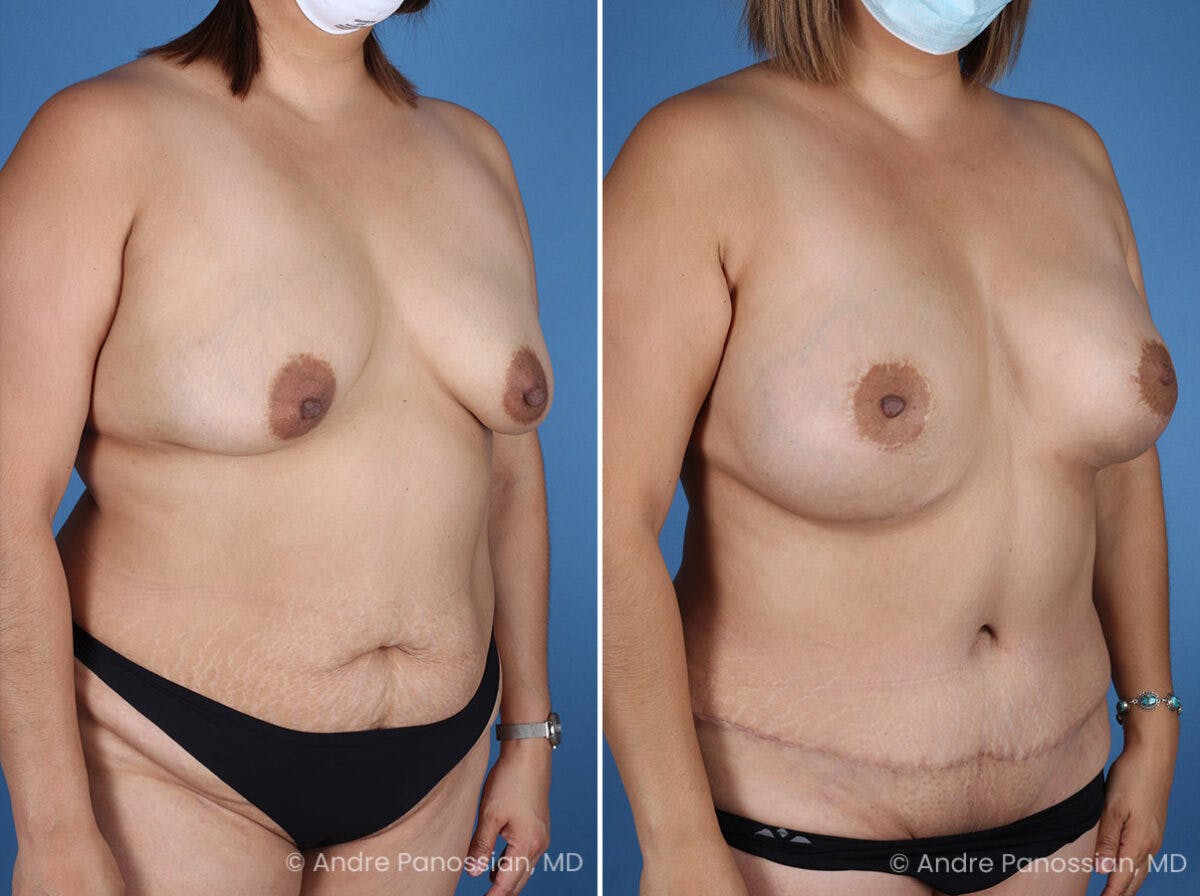 Mommy Makeover Before & After Gallery - Patient 319274 - Image 2