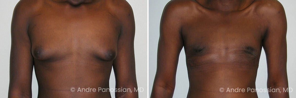 Male Breast Reduction (Gynecomastia) Before & After Gallery - Patient 267523 - Image 1
