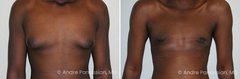 Male Breast Reduction (Gynecomastia) Before & After Gallery - Patient 267523 - Image 1