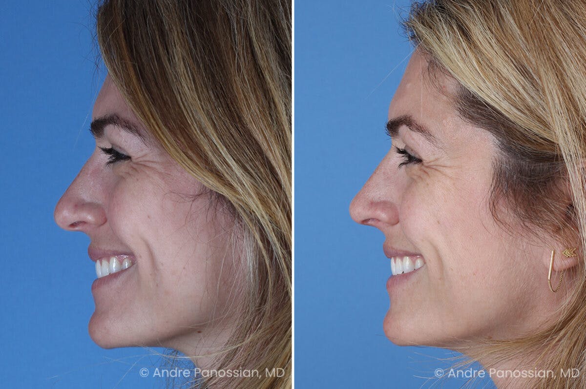 Rhinoplasty Before & After Gallery - Patient 303679 - Image 7