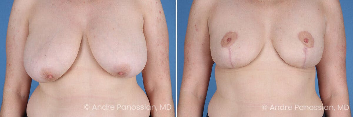 Breast Lift/Reduction Before & After Gallery - Patient 415169 - Image 1