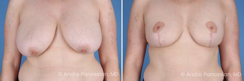 Breast Lift/Reduction Before & After Gallery - Patient 415169 - Image 1