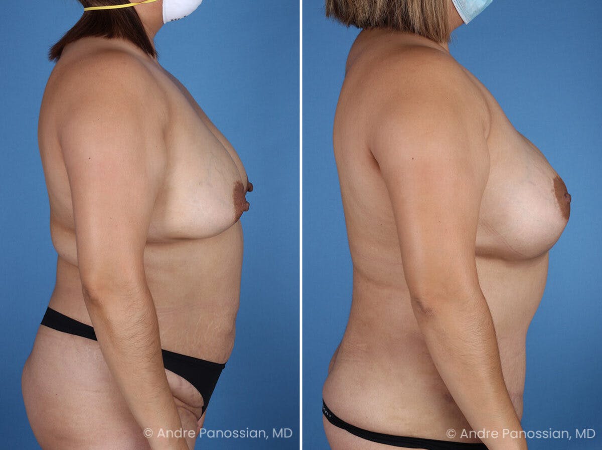 Mommy Makeover Before & After Gallery - Patient 319274 - Image 3