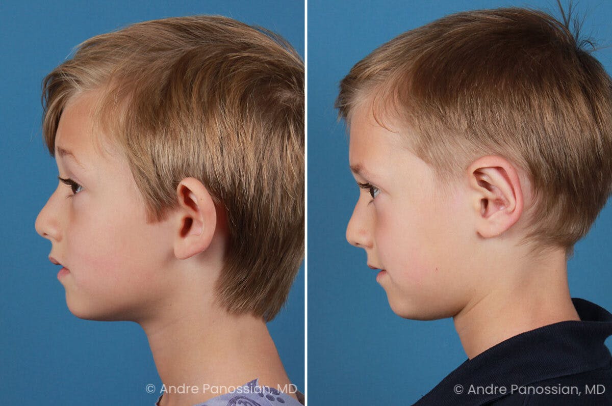 Ear Pinning (Otoplasty) Before & After Gallery - Patient 218645 - Image 5