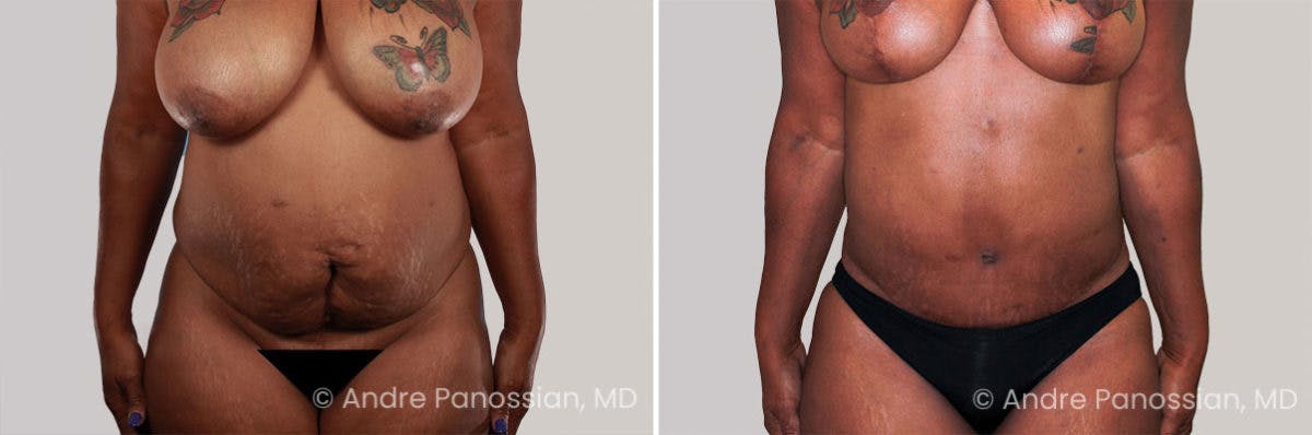 Tummy Tuck Before & After Gallery - Patient 383519 - Image 1