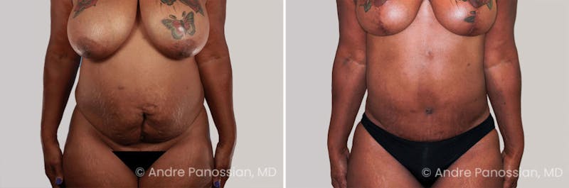 Tummy Tuck Before & After Gallery - Patient 383519 - Image 1