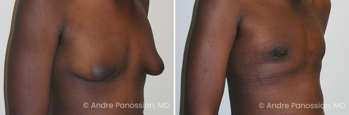 Male Breast Reduction (Gynecomastia) Before & After Gallery - Patient 267523 - Image 2