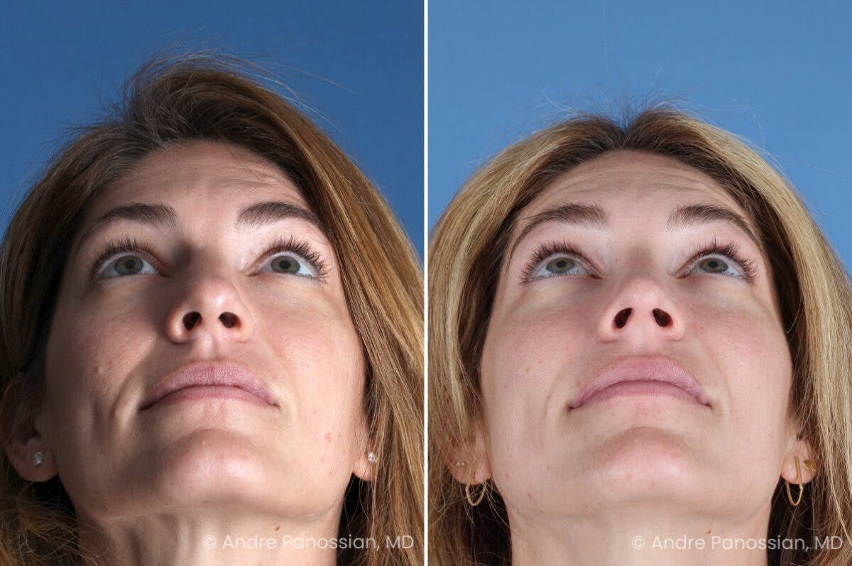 Rhinoplasty Before & After Gallery - Patient 303679 - Image 8