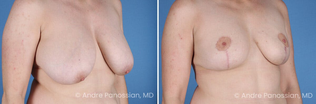Breast Lift/Reduction Before & After Gallery - Patient 415169 - Image 2