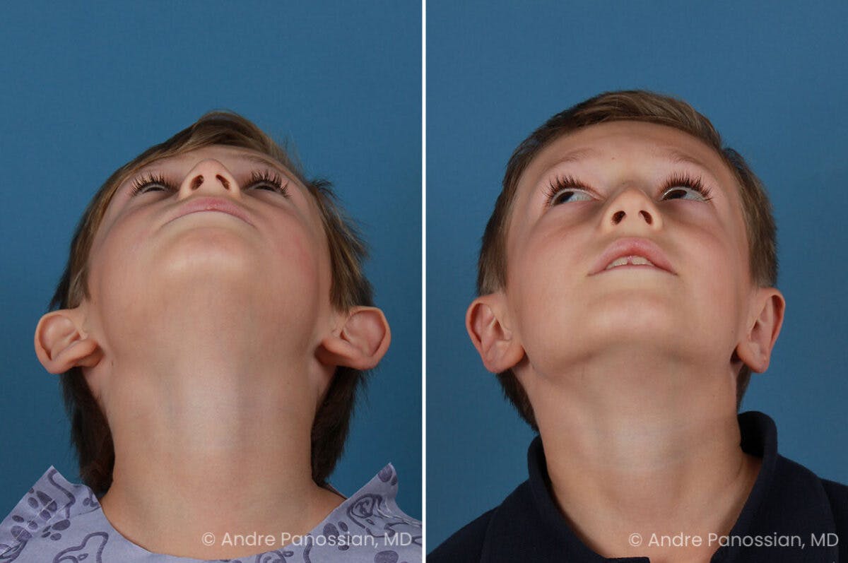 Ear Pinning (Otoplasty) Before & After Gallery - Patient 218645 - Image 6