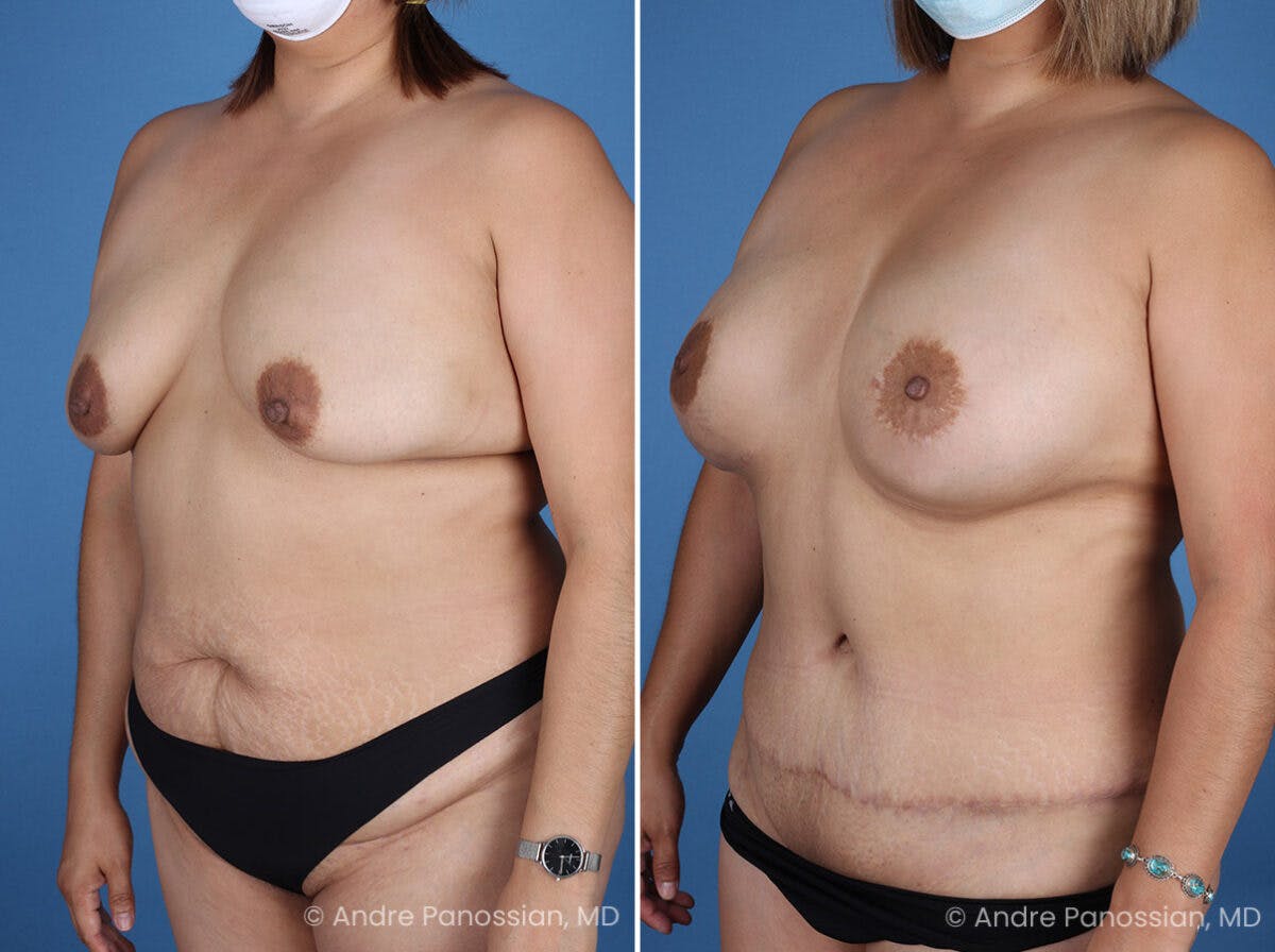 Mommy Makeover Before & After Gallery - Patient 319274 - Image 4