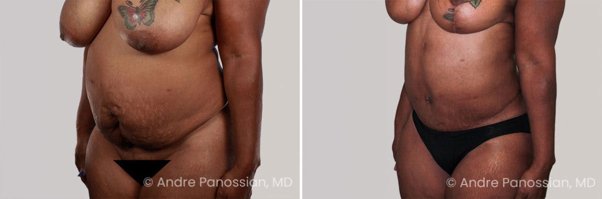 Tummy Tuck Before & After Gallery - Patient 383519 - Image 2