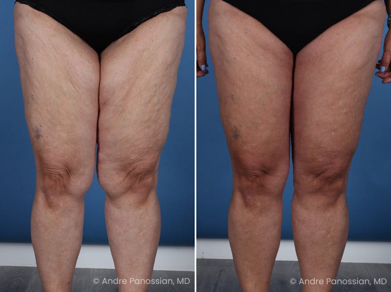 Thighplasty Before & After Gallery - Patient 219752 - Image 1