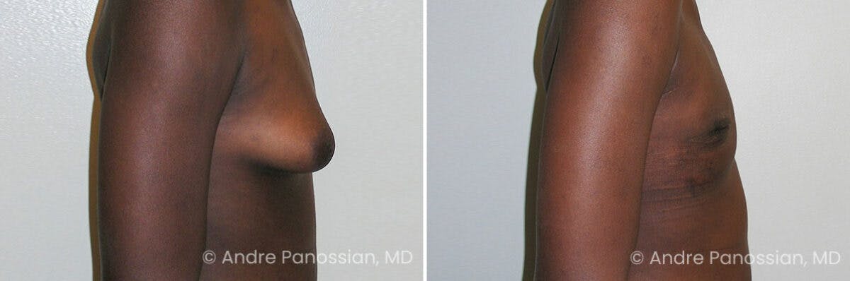 Male Breast Reduction (Gynecomastia) Before & After Gallery - Patient 267523 - Image 3