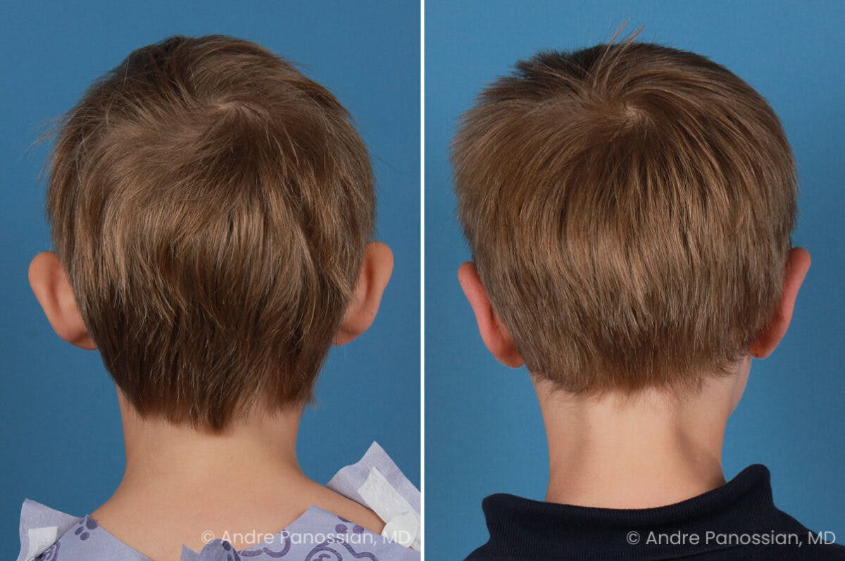 Ear Pinning (Otoplasty) Before & After Gallery - Patient 218645 - Image 7