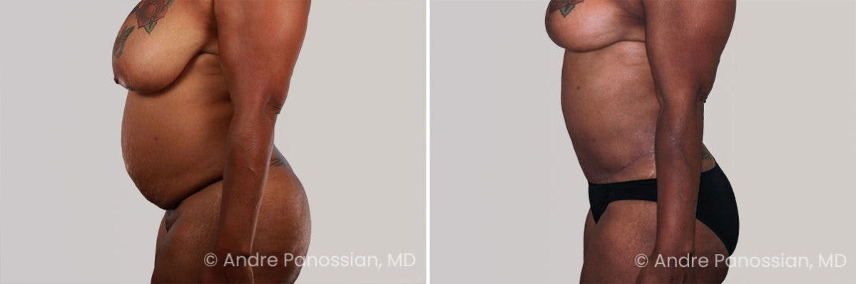 Tummy Tuck Before & After Gallery - Patient 383519 - Image 3