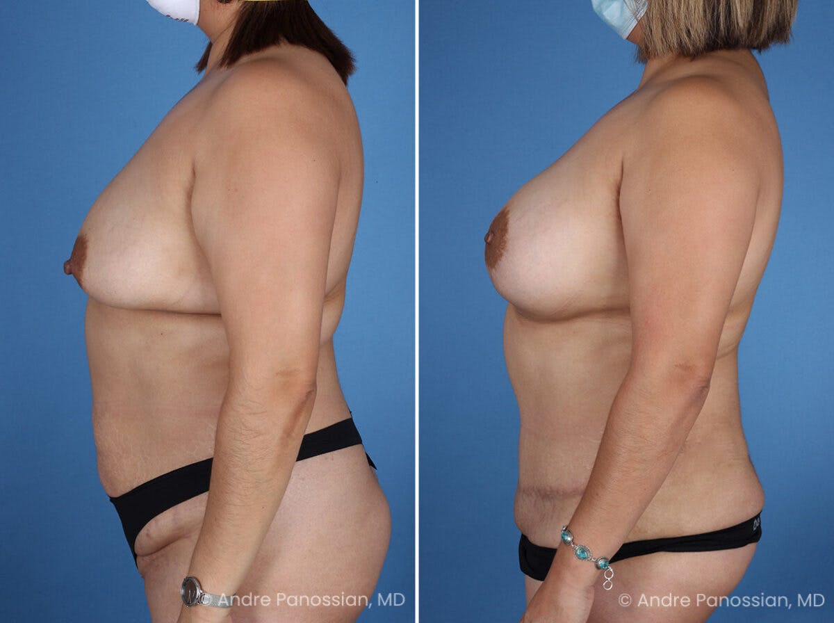 Mommy Makeover Before & After Gallery - Patient 319274 - Image 5
