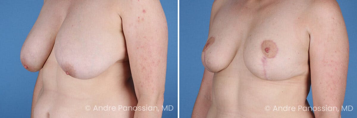Breast Lift/Reduction Before & After Gallery - Patient 415169 - Image 4