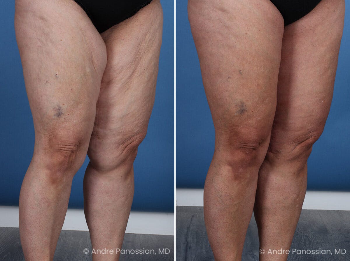 Thighplasty Before & After Gallery - Patient 219752 - Image 2