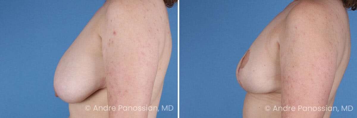 Breast Lift/Reduction Before & After Gallery - Patient 415169 - Image 5