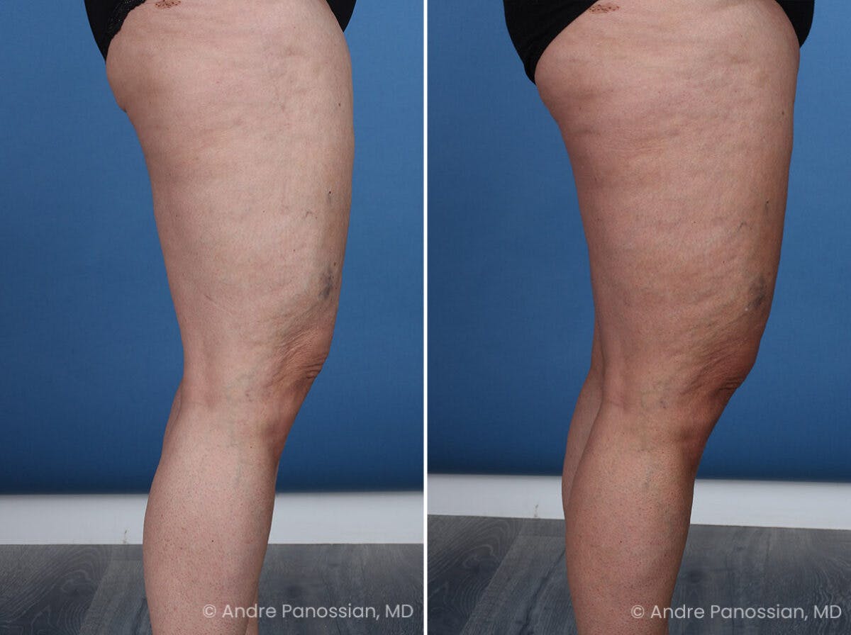 Thighplasty Before & After Gallery - Patient 219752 - Image 3