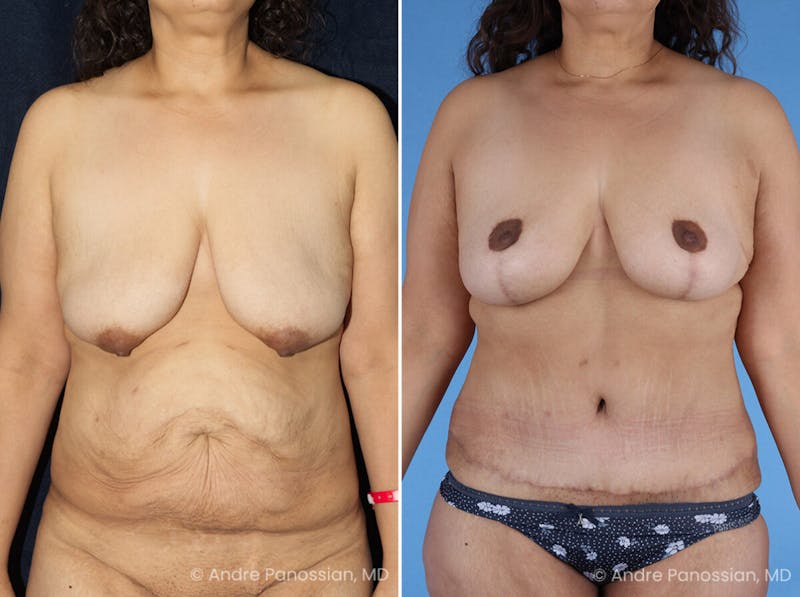 Mommy Makeover Before & After Gallery - Patient 114158 - Image 1