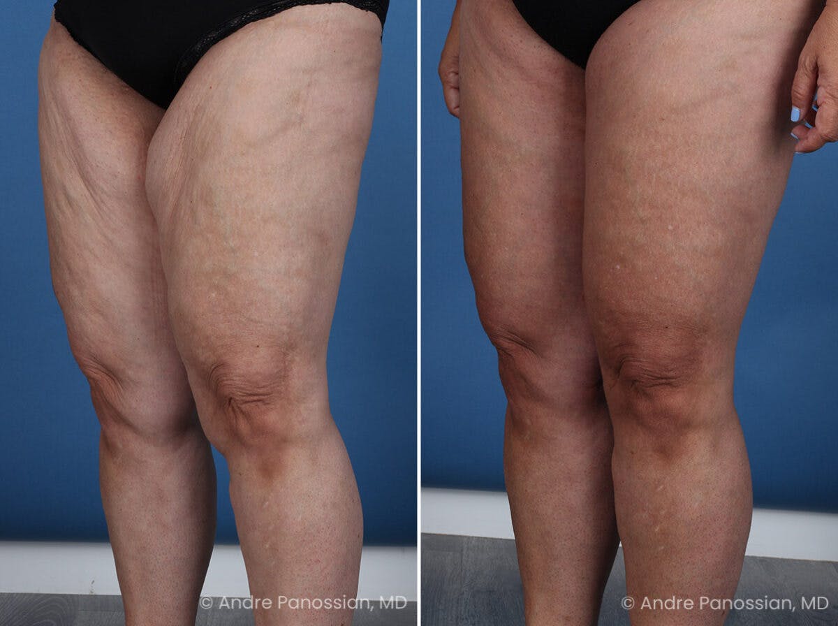 Thighplasty Before & After Gallery - Patient 219752 - Image 4