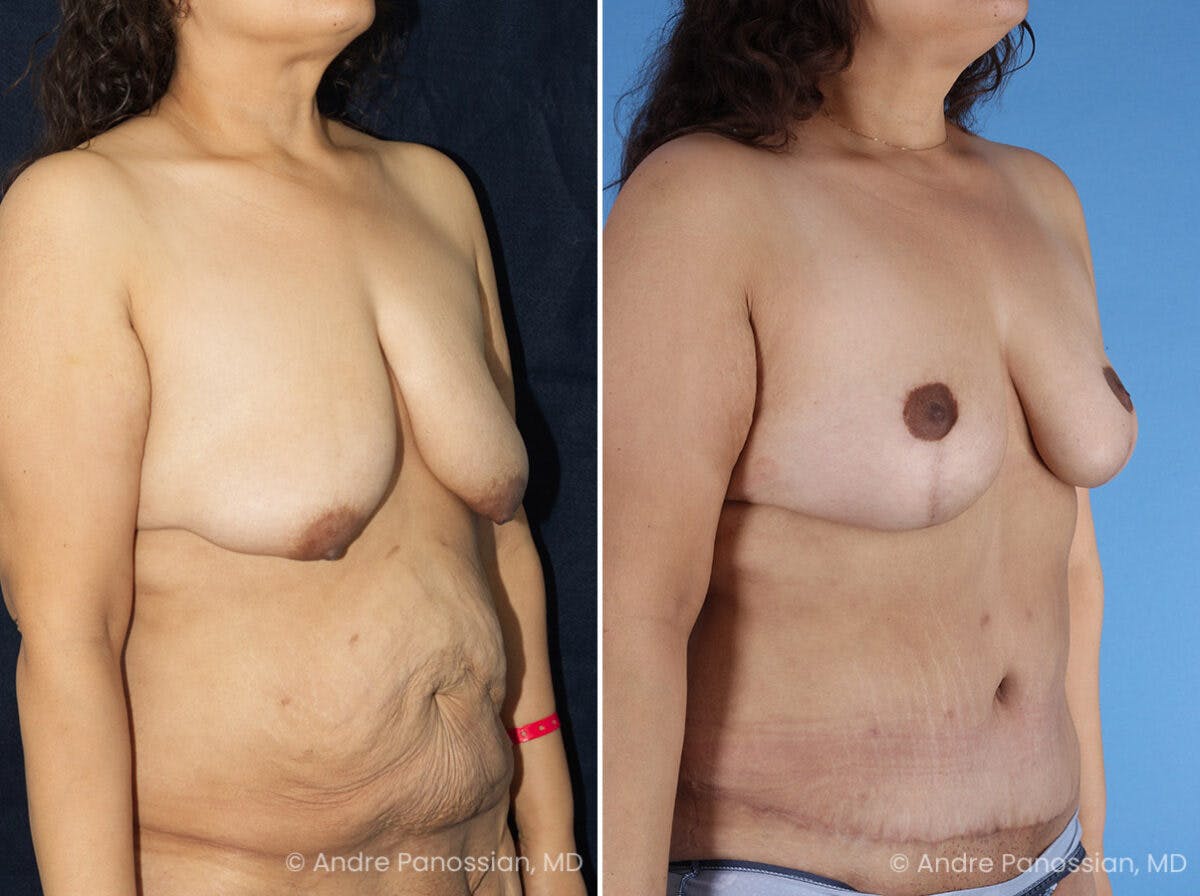 Mommy Makeover Before & After Gallery - Patient 114158 - Image 2