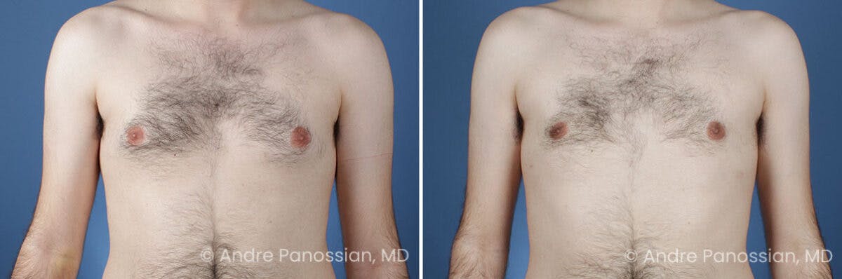 Male Breast Reduction (Gynecomastia) Before & After Gallery - Patient 228752 - Image 1