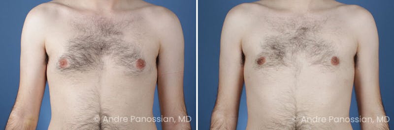 Male Breast Reduction (Gynecomastia) Before & After Gallery - Patient 228752 - Image 1