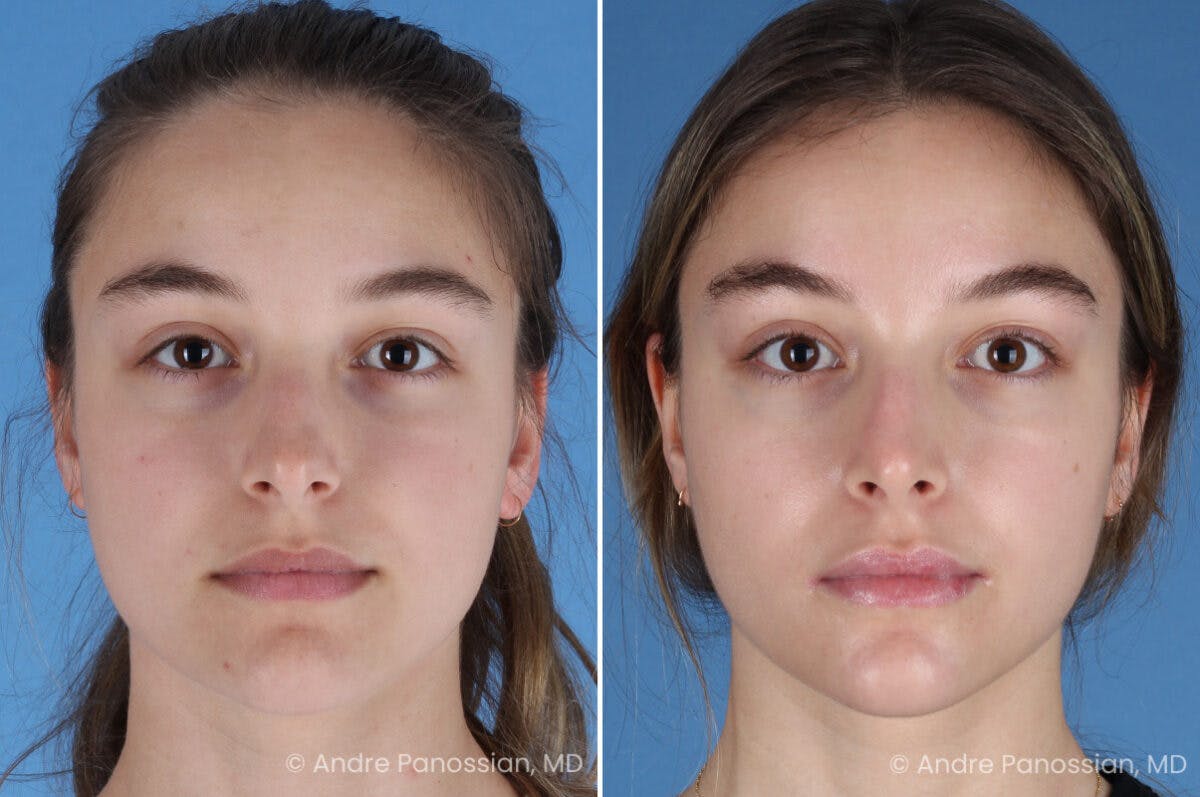 Rhinoplasty Before & After Gallery - Patient 321162 - Image 2
