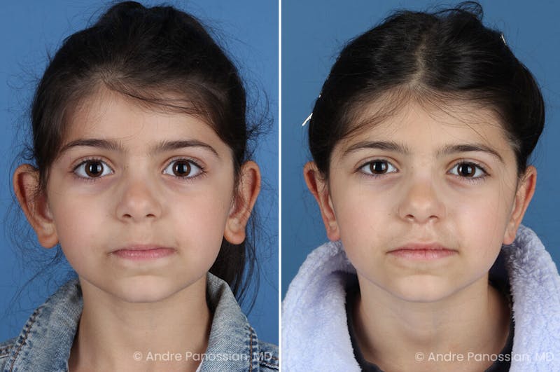 Ear Pinning (Otoplasty) Before & After Gallery - Patient 129093 - Image 1
