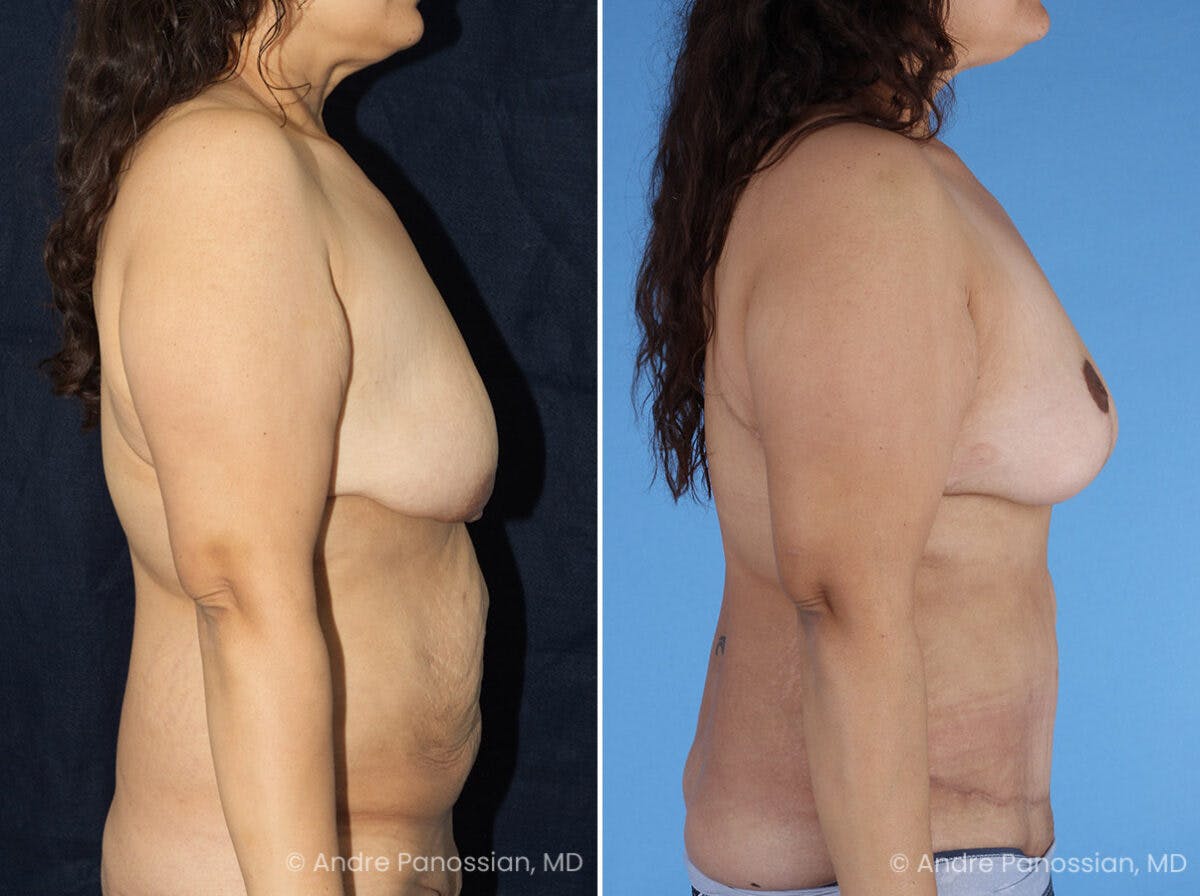Mommy Makeover Before & After Gallery - Patient 114158 - Image 3