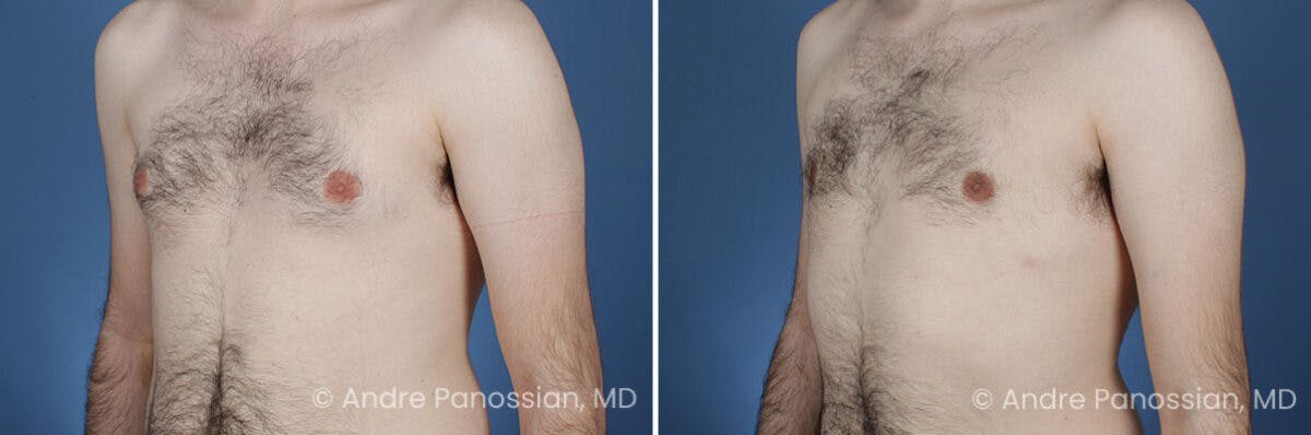 Male Breast Reduction (Gynecomastia) Before & After Gallery - Patient 228752 - Image 2