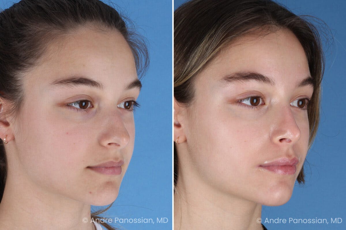 Rhinoplasty Before & After Gallery - Patient 321162 - Image 3
