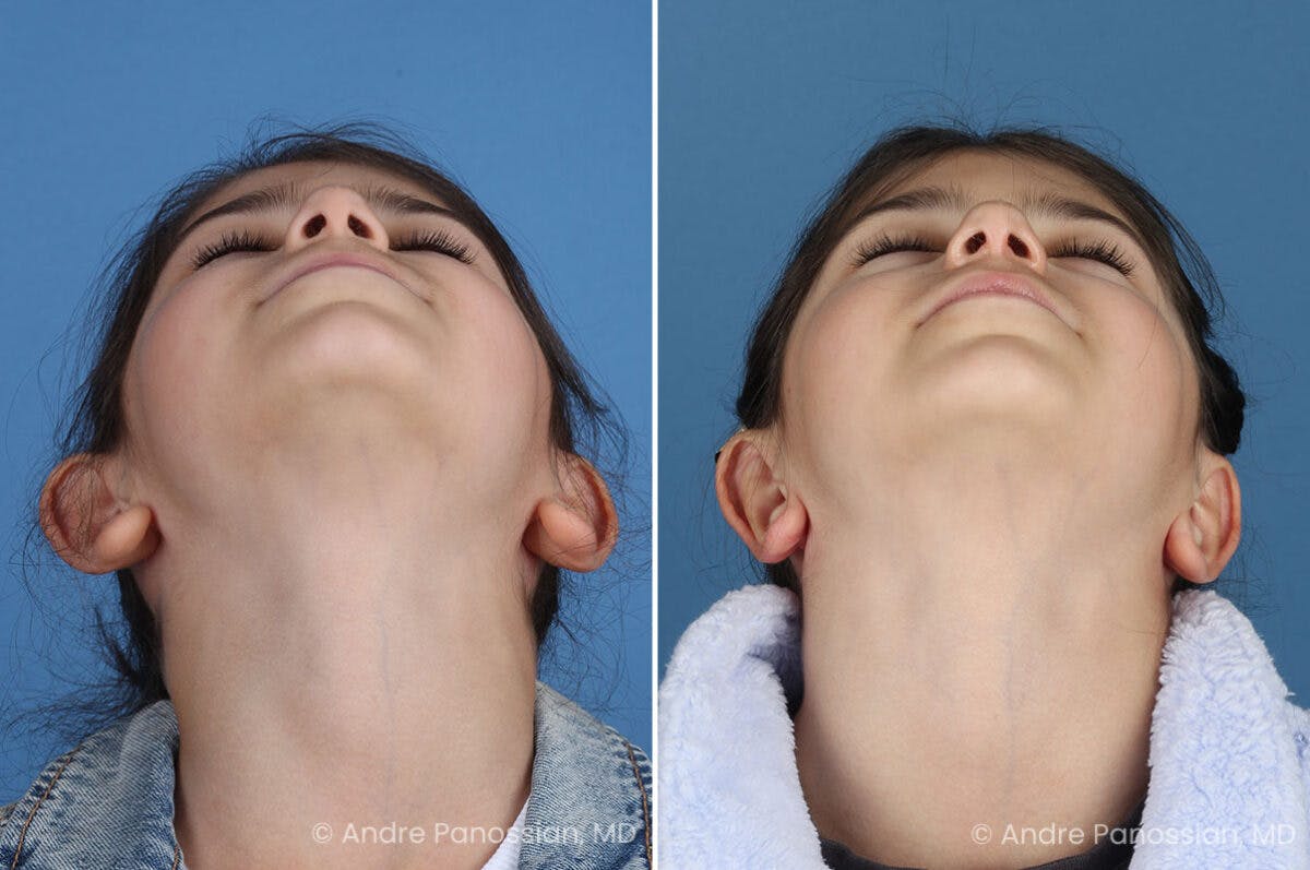 Ear Pinning (Otoplasty) Before & After Gallery - Patient 129093 - Image 2