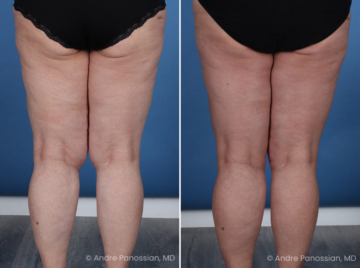 Thighplasty Before & After Gallery - Patient 219752 - Image 6
