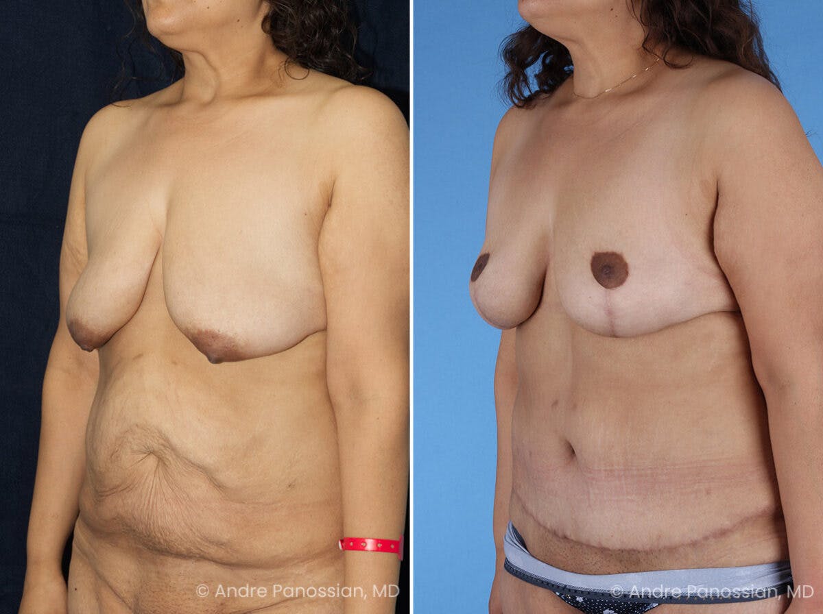 Mommy Makeover Before & After Gallery - Patient 114158 - Image 4