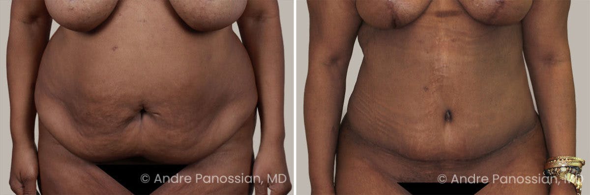 Tummy Tuck Before & After Gallery - Patient 295910 - Image 1